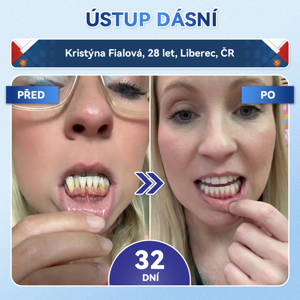 🦷Glimmerly® Microneedle naplast pro opravu zubi a dasni s Tideglusibem  |Pokročilé zubní pásky s aktivací kmenových buněk (obnovuje sklovinu a dentin • posiluje dásně • odstraňuje plak a zápach • zastavuje citlivost zubů) 3.0