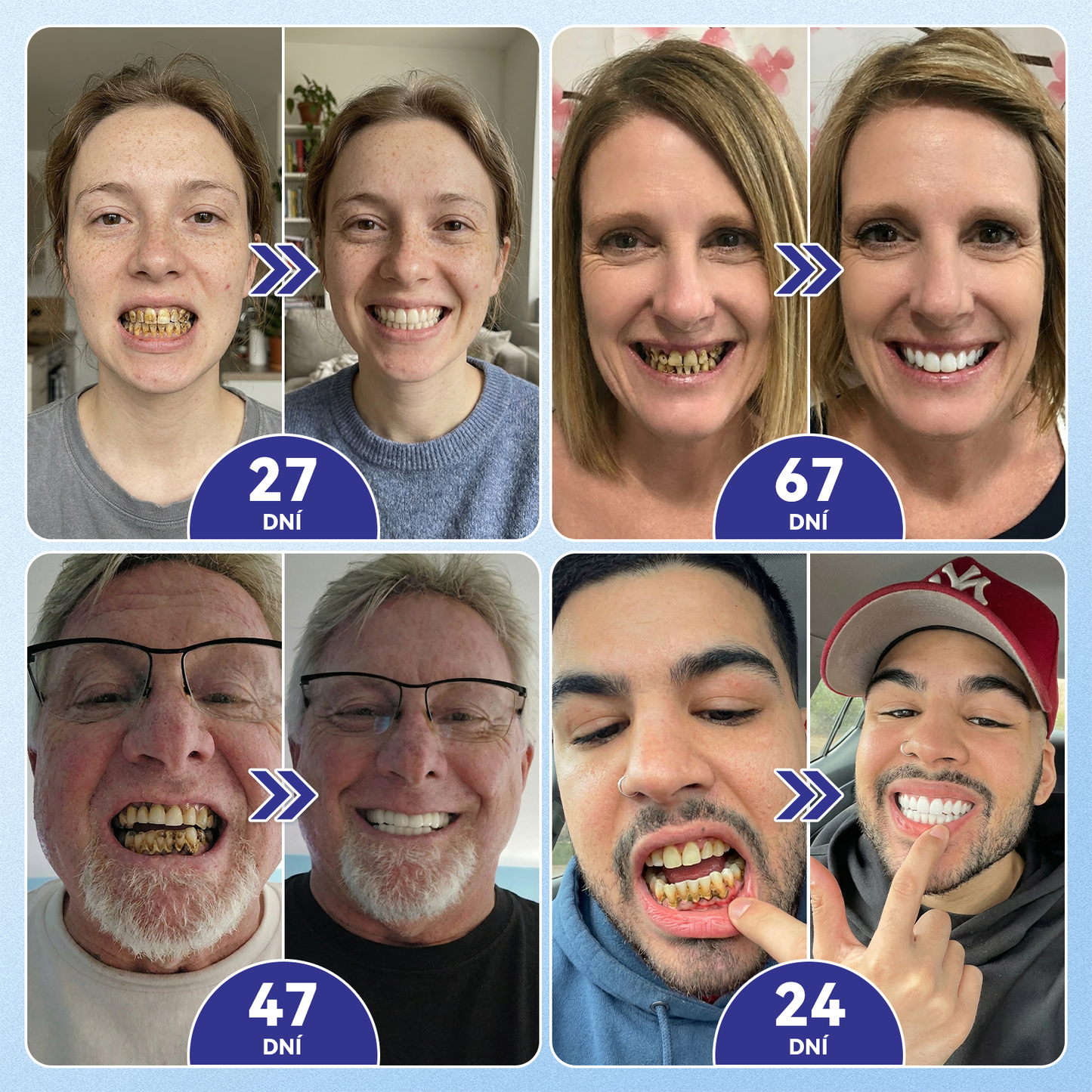 🦷Glimmerly® Microneedle naplast pro opravu zubi a dasni s Tideglusibem  |Pokročilé zubní pásky s aktivací kmenových buněk (obnovuje sklovinu a dentin • posiluje dásně • odstraňuje plak a zápach • zastavuje citlivost zubů) 3.0